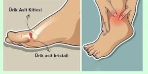 Ayaklardaki ağrının namacıylai bedendeki çok ürik asit olabilir