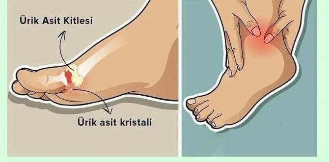 Ayaklardaki ağrının namacıylai bedendeki çok ürik asit olabilir
