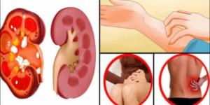 Böbrek K-a’n serinin Bu Belirtilerine D!kkat!