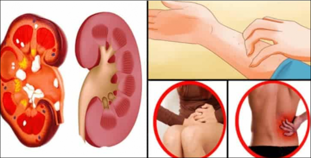 Böbrek K-a’n serinin Bu Belirtilerine D!kkat!