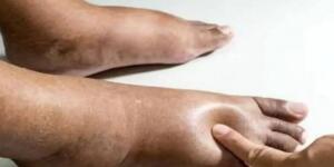 Ayak Bacak Şişmesi Ba’kın Neyin Belirtisi